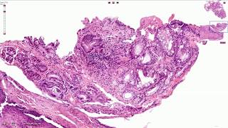 Barrett Esophagus  Histopathology [upl. by Onailerua]