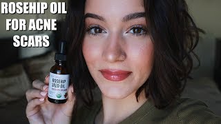 TRYING ROSEHIP OIL FOR A MONTH FOR ACNE SCARS [upl. by Atiuqer802]