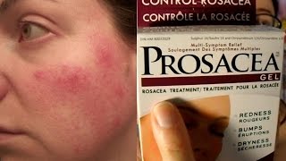 Prosacea Rosacea Treatment Product Review not sponsored  Rosy JulieBC [upl. by Nevets]