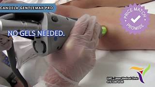 Candela GentleMax Pro  Best Laser Hair Removal Machine at LMC  Laser Medical Clinic [upl. by Virgy]