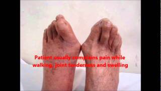 HOW TO MANAGE BUNION  Hallux Valgus both Great Toes [upl. by Marceau754]