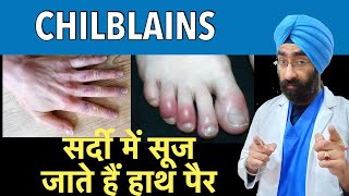 Chilblains  सर्दी में सूज जाते हैं हाथ पैर  Swollen hands and fingers in Winter  DrEducation [upl. by Annahavas]