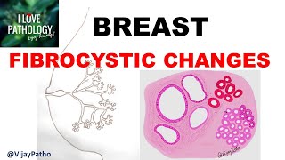 Diseases of Breast Part 1 Normal anatomy Classification amp FIBROCYSTIC CHANGES [upl. by Enneira50]