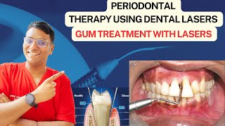 Dr Rudra Mohan  Use of Lasers in Periodontal Gum Treatment  Non Invasive Gum Treatment [upl. by Alletniuq]