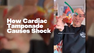 How Cardiac Tamponade Causes Shock [upl. by Nnayllehs862]