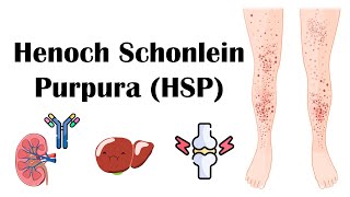 Henoch Schoenlein Purpura HSP  Causes Pathophysiology Diagnosis And Treatment [upl. by Eemiaj741]