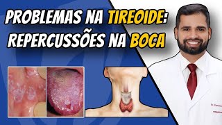 Hipotireoidismo e hipertireoidismo Sinais na boca de problemas na tireóide tireoide [upl. by Janos866]