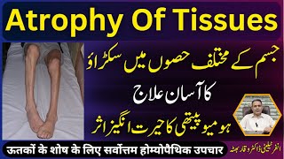 Atrophy Of Tissues جسم مین سکڑاؤ शारीरिक संकुचन Homeopathic Treatment In Urdu  Hindi [upl. by Anoiek226]