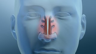 Nasal Turbinate Reduction [upl. by Mireille]