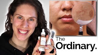 THE ORDINARY  3 BEST DARK SPOTS amp PIGMENTATION PRODUCTS [upl. by Gerdeen]