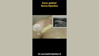 Master The Shoulder Sono Guided Bursal Injection With This Expert Tutorial [upl. by Asaret]