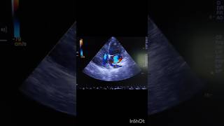 echocardiography echocardiography video echo caseGlobal hypokinesia echo [upl. by Viddah26]