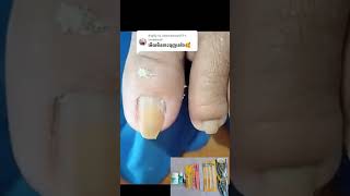 Thick toenail treatment nail​​​ asmr fyp ear shorts viral wax [upl. by Hochman]