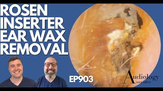 ROSEN INSERTER EAR WAX REMOVAL amp OTHERS  EP903 [upl. by Muraida]