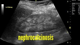 Bilateral nephrocalcinosis ultrasound and color Doppler video [upl. by Suckow]