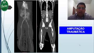 Angiotomografia de aorta e MMII CASOS [upl. by Yenoh]