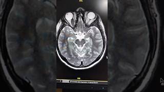 Optic Nerve Glioma [upl. by Nitnert]