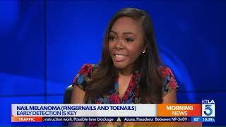 Nurse Alice on KTLA What is nail melanoma [upl. by Staley]