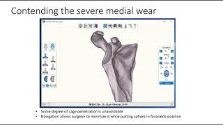 Exactech GPS Preoperative Planning Examples [upl. by Donald357]