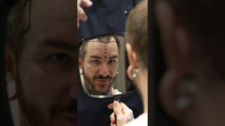 Cosmedica Clinic Hair Transplant in Turkey shorts hairtransplant video [upl. by Nissa]