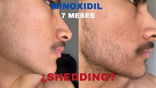 7 MESES USANDO MINOXIDIL PARA CRECER BARBA SIENDO 100 LAMPIÑO [upl. by Ymor]