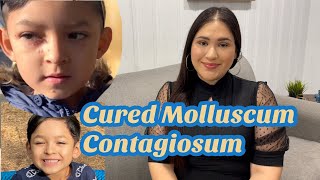 How we curedtreated molluscum contagiosum update 2021  How to get rid of molluscum contagiosum [upl. by Happy]