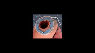 Adjustable Gastric Band [upl. by Chaiken176]