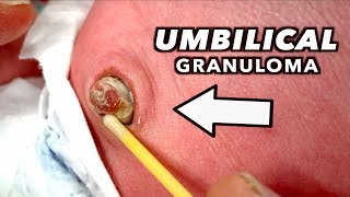 LARGE UMBILICAL GRANULOMA Cauterized with Silver Nitrate  Dr Paul [upl. by Ardeed800]