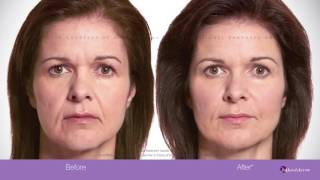 Allergan Botox [upl. by Now]