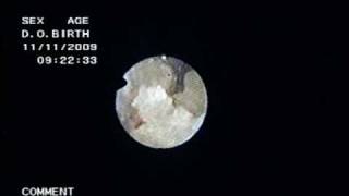 Holmium laser to lower pole cystine stonewmv [upl. by Notlrac196]