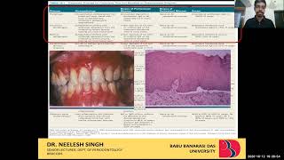 BDS 406 PERIODONTOLOGY DESQUAMATIVE GINGIVITIS DR NEELESH SINGH [upl. by Nalyorf617]