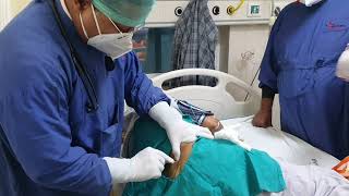 Bone Marrow Aspiration and Biopsy Dr Sandeep Kumar garg Nutema Hospital [upl. by Lachance685]