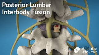 Posterior Lumbar Interbody Fusion PLIF [upl. by Annaira]