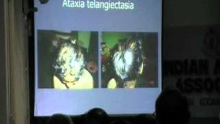 Ataxia telangiectasia  DrJBhaskar  Part 1 of 2 [upl. by Fortunato910]