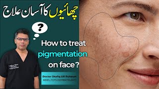 How to treat pigmentation on face   Doctor Shafiq Ur Rehman [upl. by Marlena139]