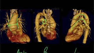 Mediastinal CXR anatomy [upl. by Yadnus]