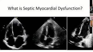 Cardiac Dysfunction in Sepsis [upl. by Garrik60]