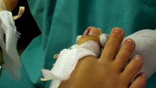 Ingrown Toenail Removal [upl. by Kcitrap]