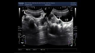 Ultrasound Video showing a Cervical Cyst [upl. by Einnij715]