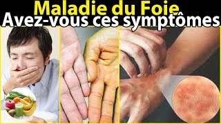 Les symptômes de la maladie du foie [upl. by Lalita]