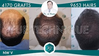 Injerto Capilar Técnica FUE – 4170 Grafts 9653 Pelos – Dr Rafael de Freitas [upl. by Alinna291]