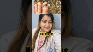 toenails podologia fungus trending nails infection treatment youtubeshorts foryou skincare [upl. by Annaehs]