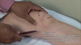 Knee Injection  Medial Approach [upl. by Ainnos738]