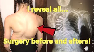 Scoliosis surgery before and afters  I reveal all [upl. by Oilisab]