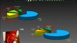 Évolution des résultats de la chirurgie pour le traitement des cancers de l’oesophage [upl. by Aurita]
