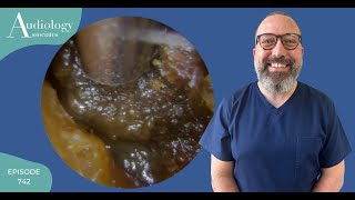 VERY FULL EAR WAX amp SKIN REMOVAL  EP742 [upl. by Gyimah]