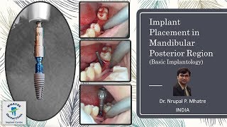 Implant Placement in Mandibular Posterior Region Basic Implantology by Straumann BLT Implant [upl. by Annais]