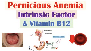 Pernicious Anemia Rare Cause of Vitamin B12 Deficiency  Causes Symptoms Diagnosis Treatment [upl. by Peg926]