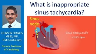 What is inappropriate sinus tachycardia [upl. by Ttenyl]