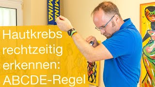 Hautkrebs rechtzeitig erkennen ✅ ABCDERegel [upl. by Digdirb]